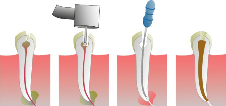 Hybrid Dental Implants