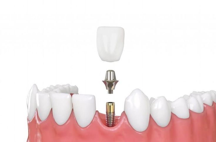 Hybrid Dental Implants