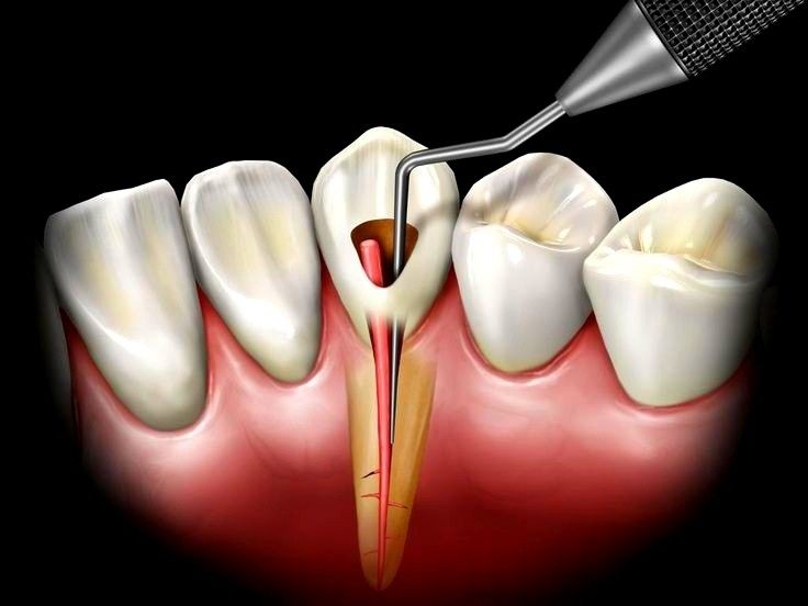 Hybrid Dental Implants working